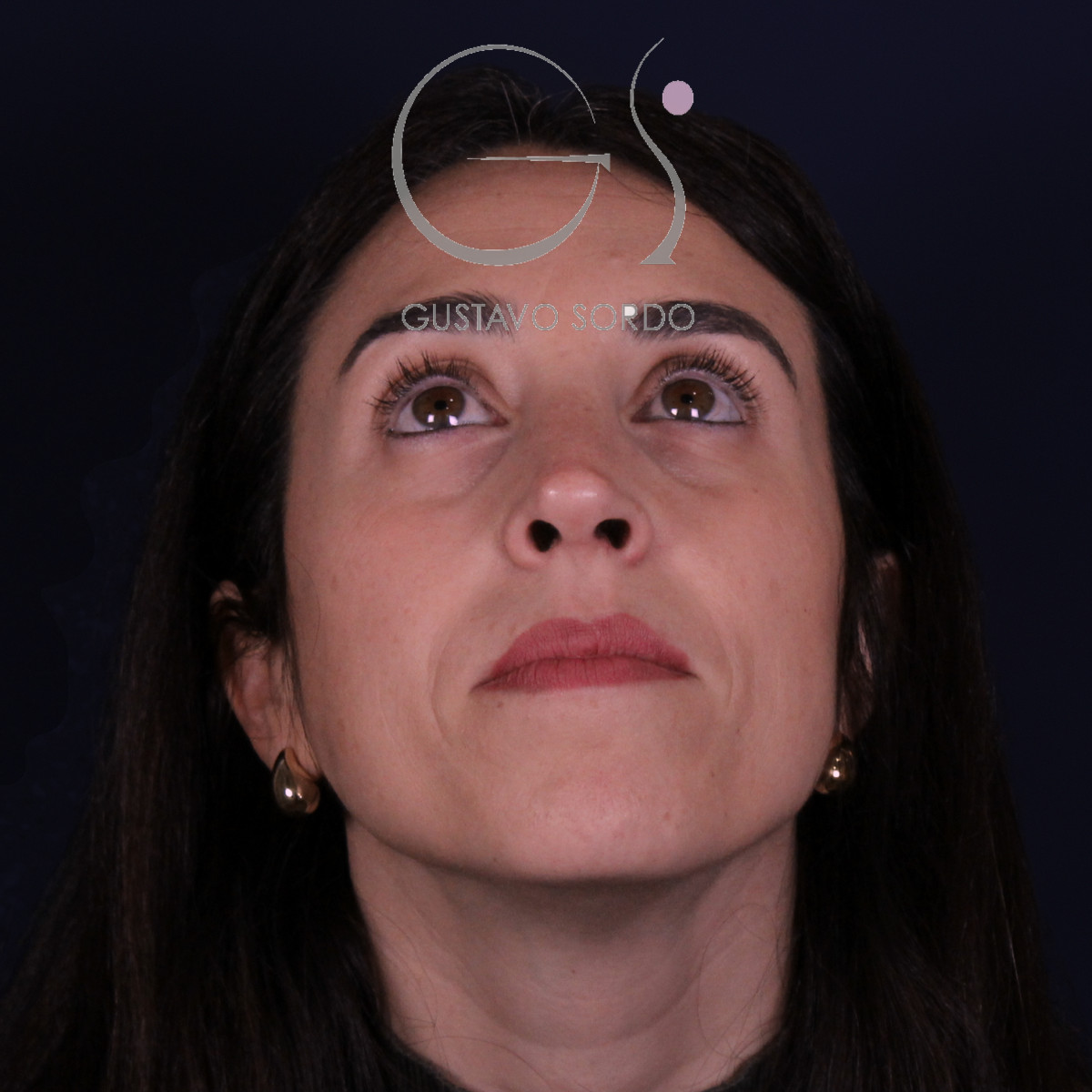 Rinoplastia híbrida en nariz aguileña, mentón arriba, a los 6 meses de la operación