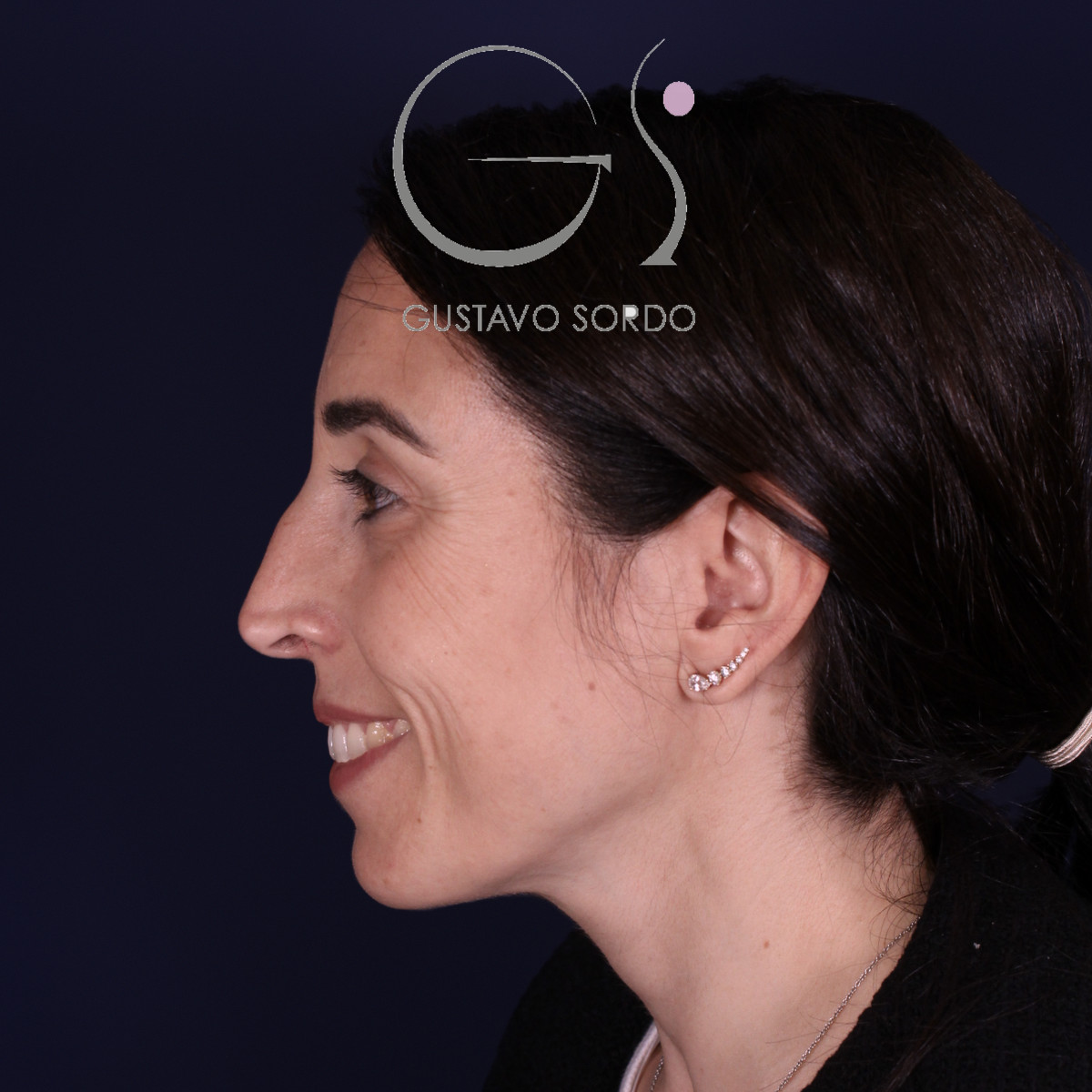 Rinoplastia híbrida en nariz aguileña, perfil izquierdo sonriendo, antes de la operación