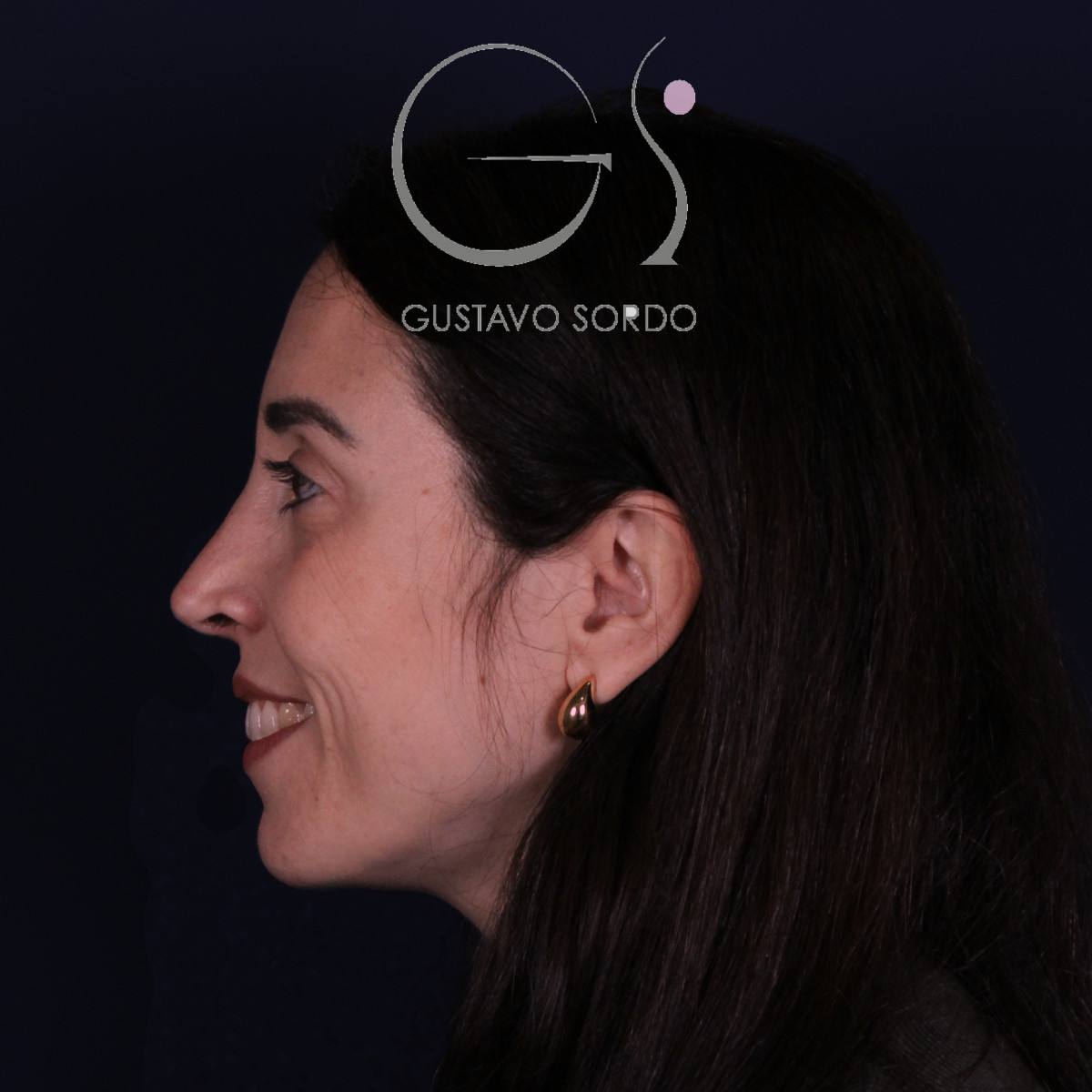 Rinoplastia híbrida en nariz aguileña, perfil izquierdo sonriendo, a los 6 meses de la operación