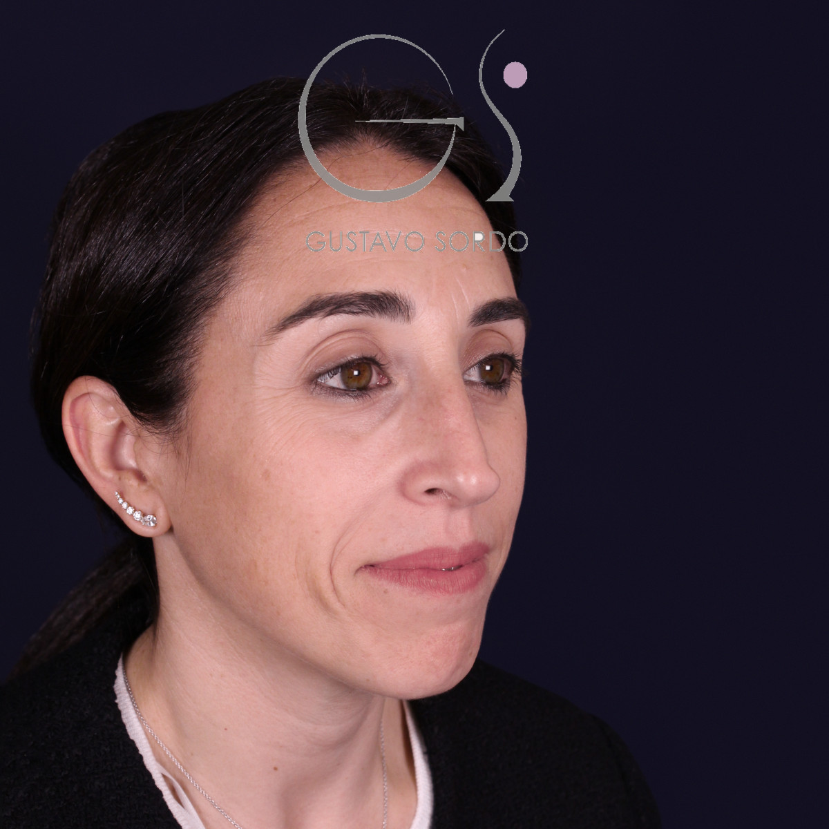 Rinoplastia híbrida en nariz aguileña, semiperfil derecho, antes de la operación