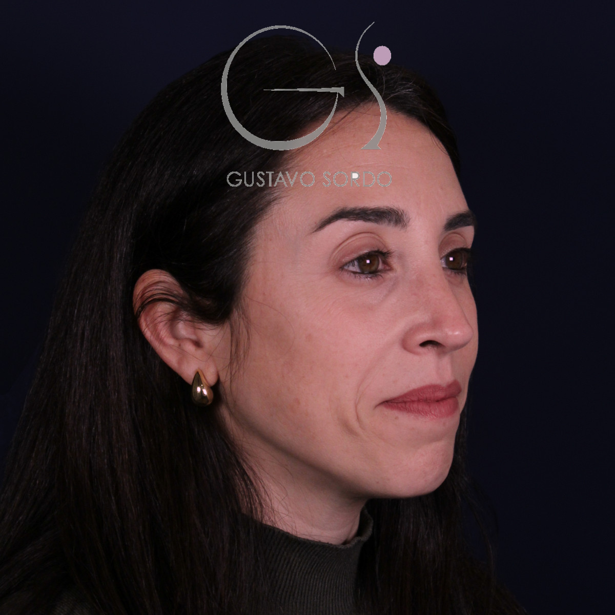Rinoplastia híbrida en nariz aguileña, semiperfil derecho, a los 6 meses de la operación