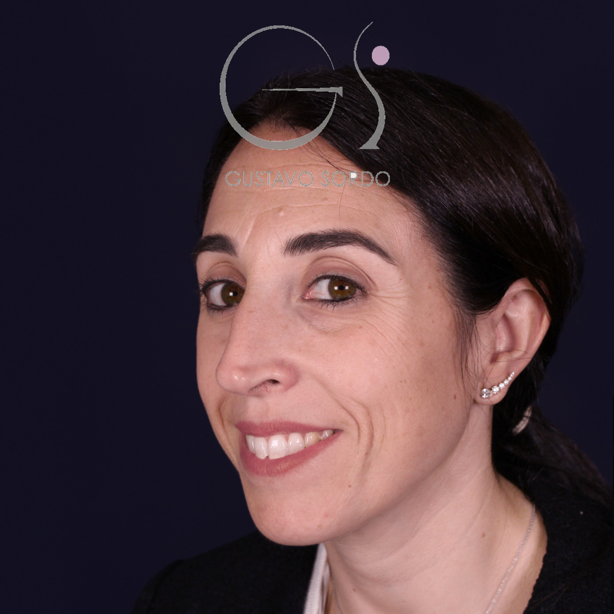 Rinoplastia híbrida en nariz aguileña, semiperfil izquierdo sonriendo, antes de la operación