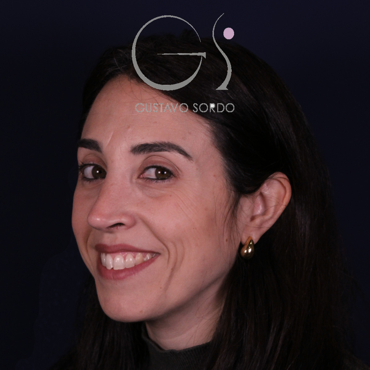 Rinoplastia híbrida en nariz aguileña, semiperfil izquierdo sonriendo, a los 6 meses de la operación