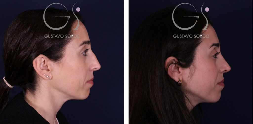 Rinoplastia — nariz aguileña: antes y después de un caso operado en Madrid