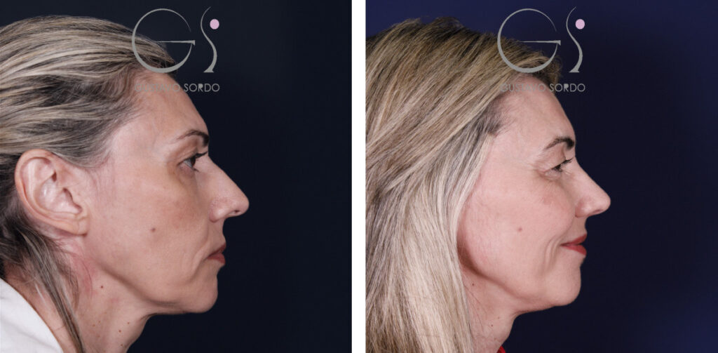 Rinoplastia: antes y después de un caso operado en Madrid