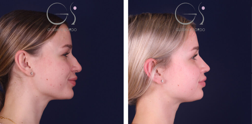 Rinoplastia — nariz recta, resultado natural: antes y después de un caso operado en Madrid