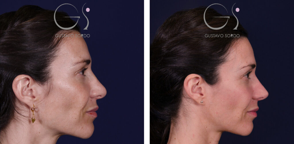 Rinoplastia: antes y después de un caso operado en Madrid