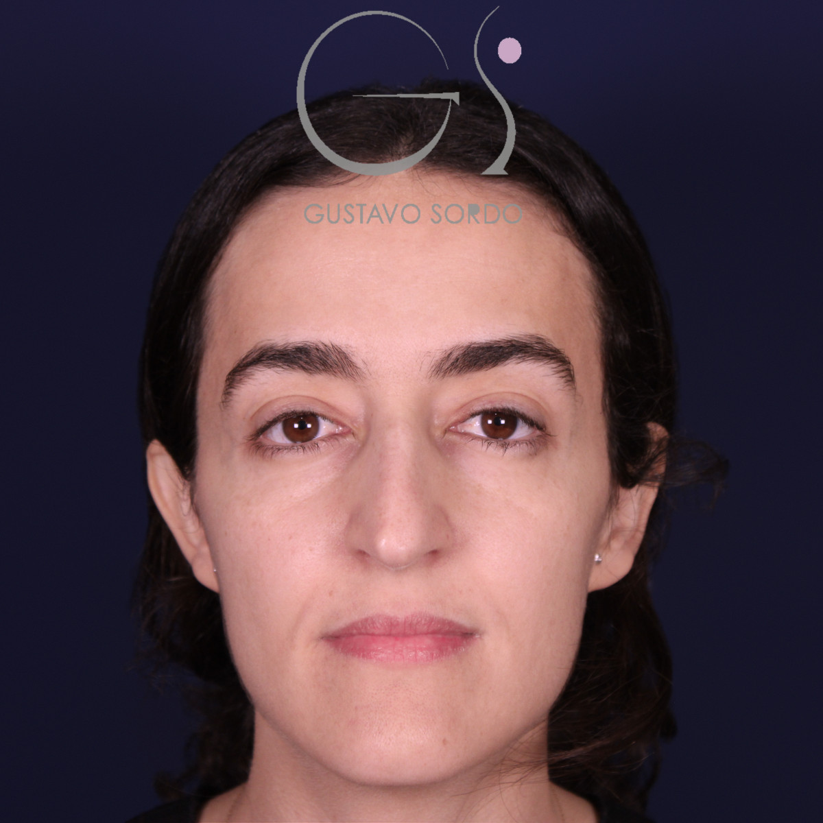 Rinoplastia de preservación en nariz aguileña con giba en S, vista frontal, antes de la operación