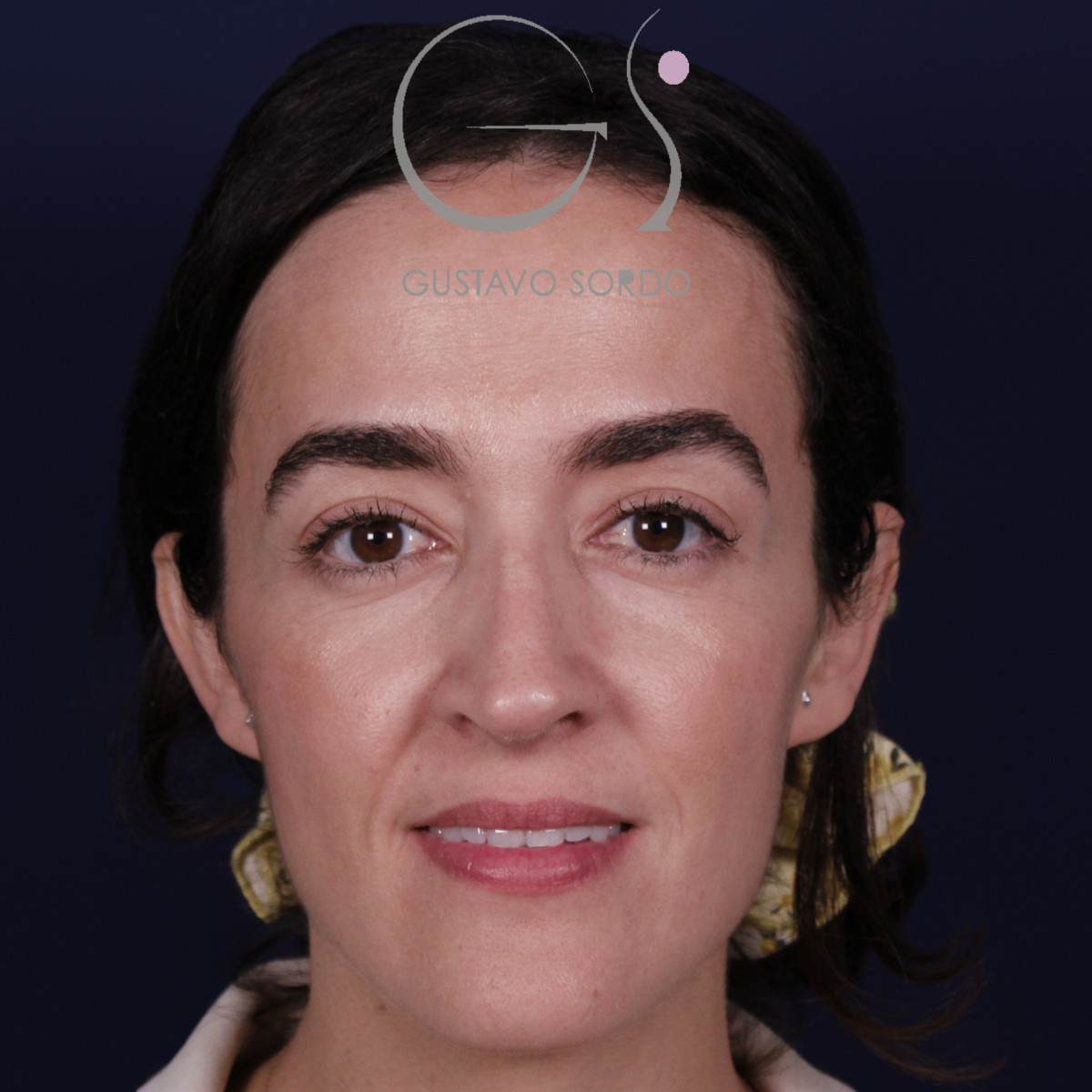Rinoplastia de preservación en nariz aguileña con giba en S, vista frontal, a los 6 meses de la operación