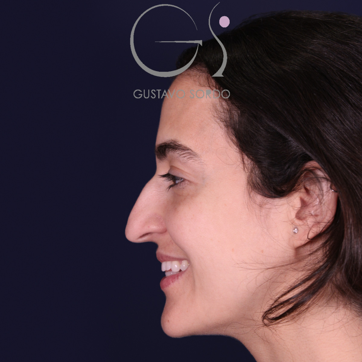 Rinoplastia de preservación en nariz aguileña con giba en S, perfil izquierdo sonriendo, antes de la operación