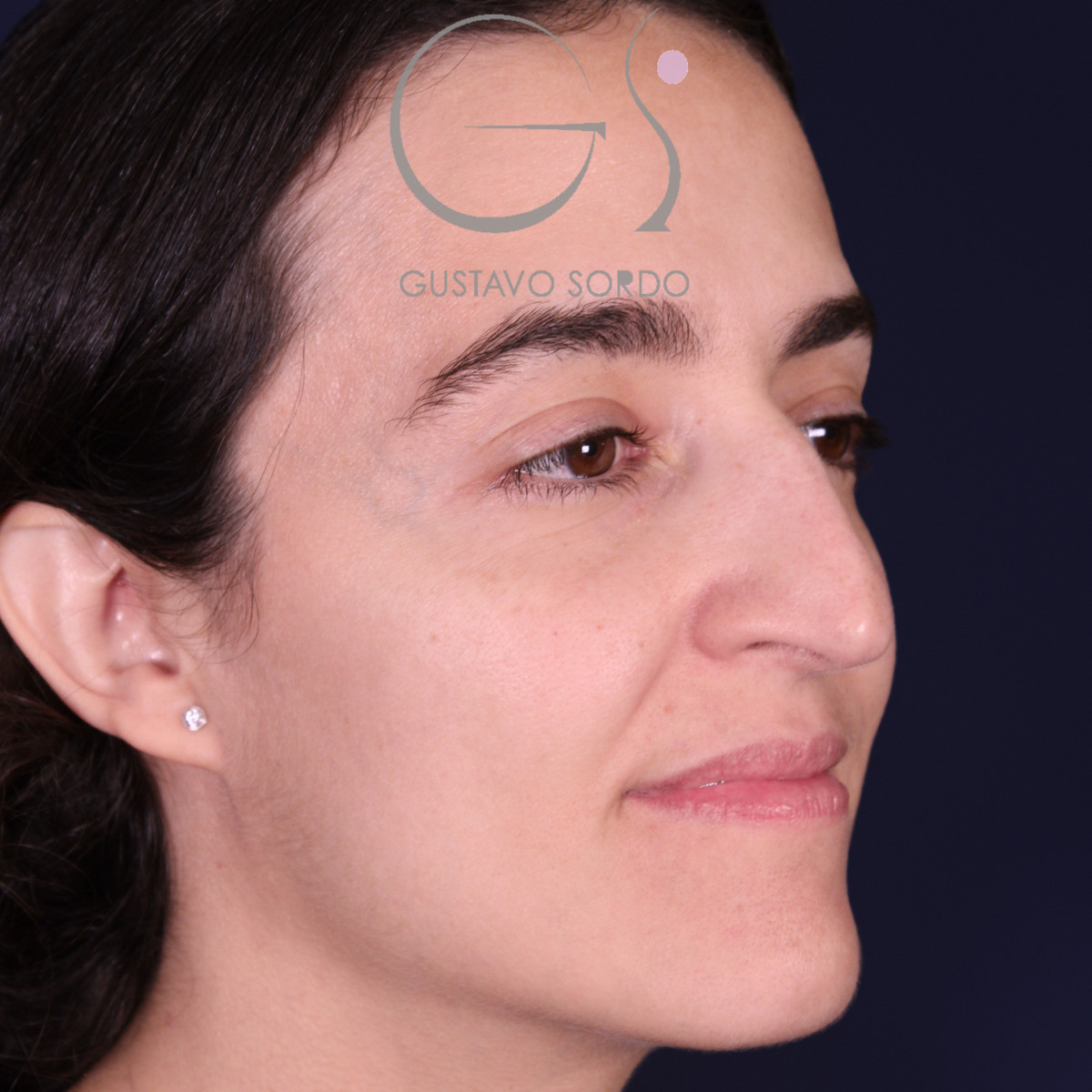 Rinoplastia de preservación en nariz aguileña con giba en S, semiperfil derecho, antes de la operación