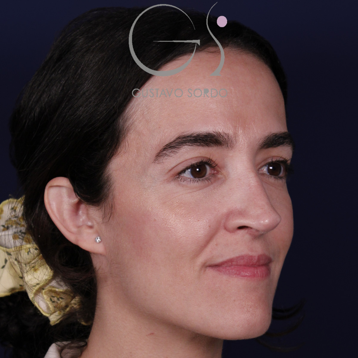 Rinoplastia de preservación en nariz aguileña con giba en S, semiperfil derecho, a los 6 meses de la operación