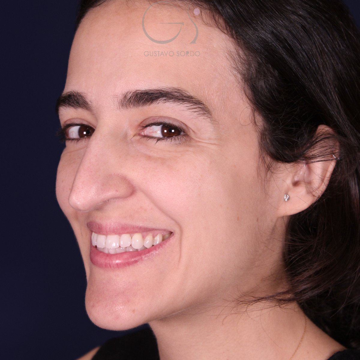 Rinoplastia de preservación en nariz aguileña con giba en S, semiperfil izquierdo sonriendo, antes de la operación