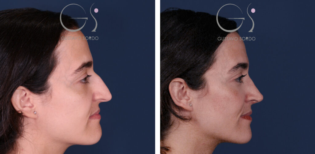 Rinoplastia — nariz aguileña: antes y después de un caso operado en Madrid