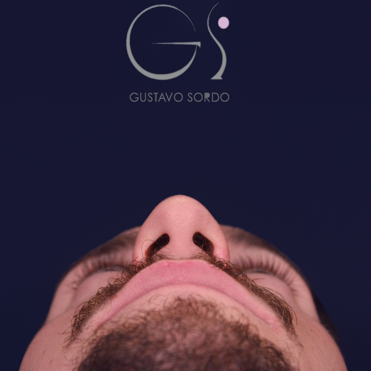 Rinoplastia de preservación low strip en desviación axial de la pirámide, vista basal, antes de la operación