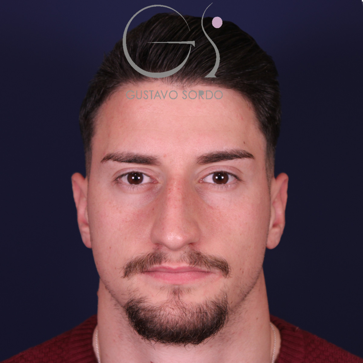 Rinoplastia de preservación low strip en desviación axial de la pirámide, vista frontal, antes de la operación