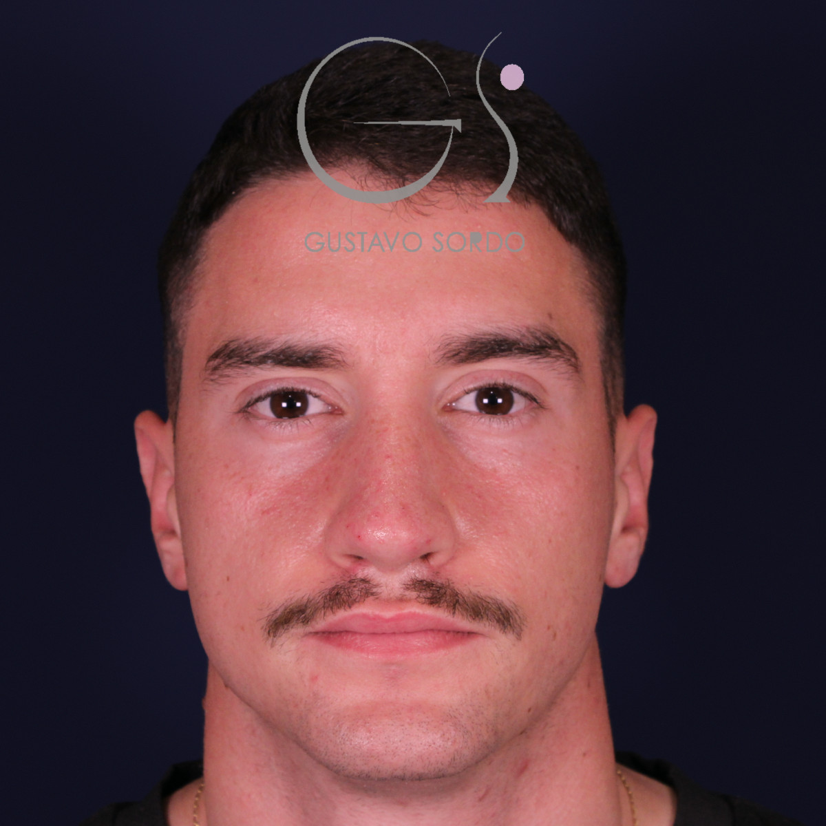 Rinoplastia de preservación low strip en desviación axial de la pirámide, vista frontal, al año de la operación
