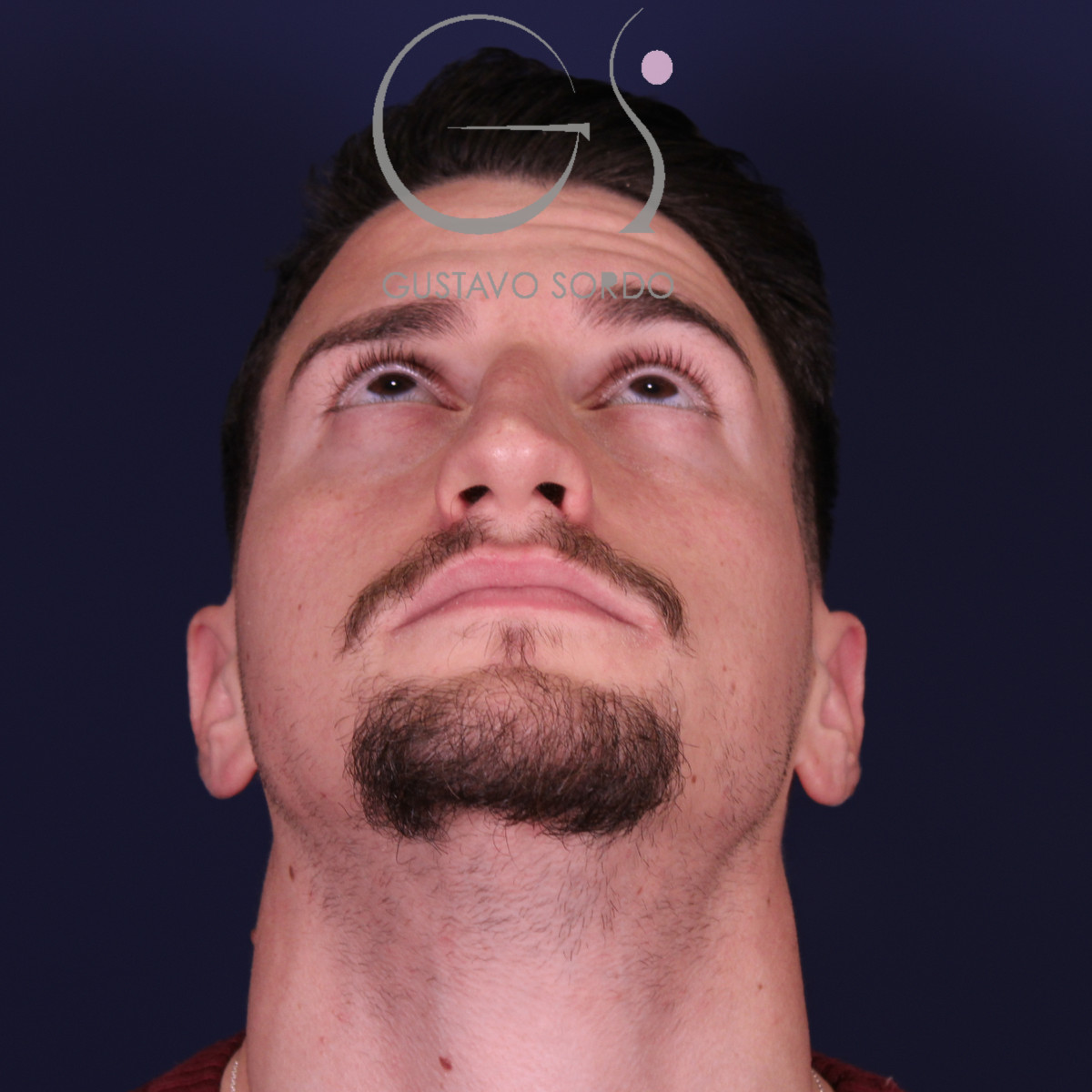 Rinoplastia de preservación low strip en desviación axial de la pirámide, mentón arriba, antes de la operación