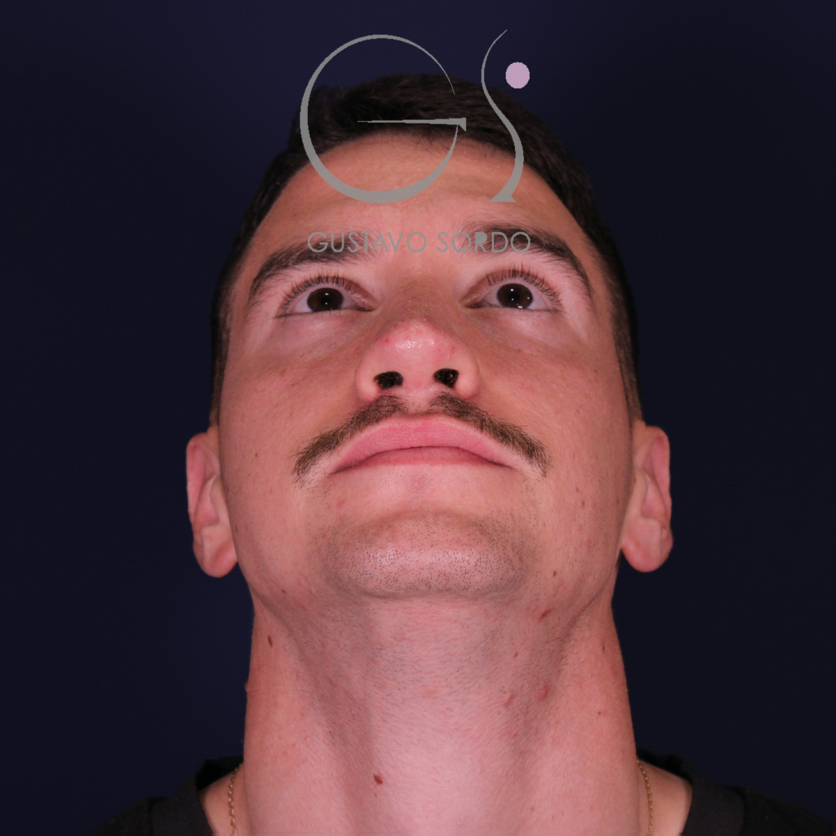 Rinoplastia de preservación low strip en desviación axial de la pirámide, mentón arriba, al año de la operación