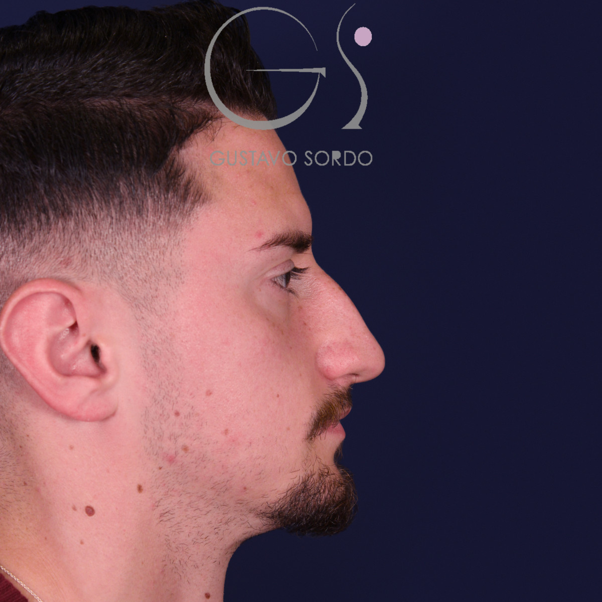 Rinoplastia de preservación low strip en desviación axial de la pirámide, perfil derecho, antes de la operación