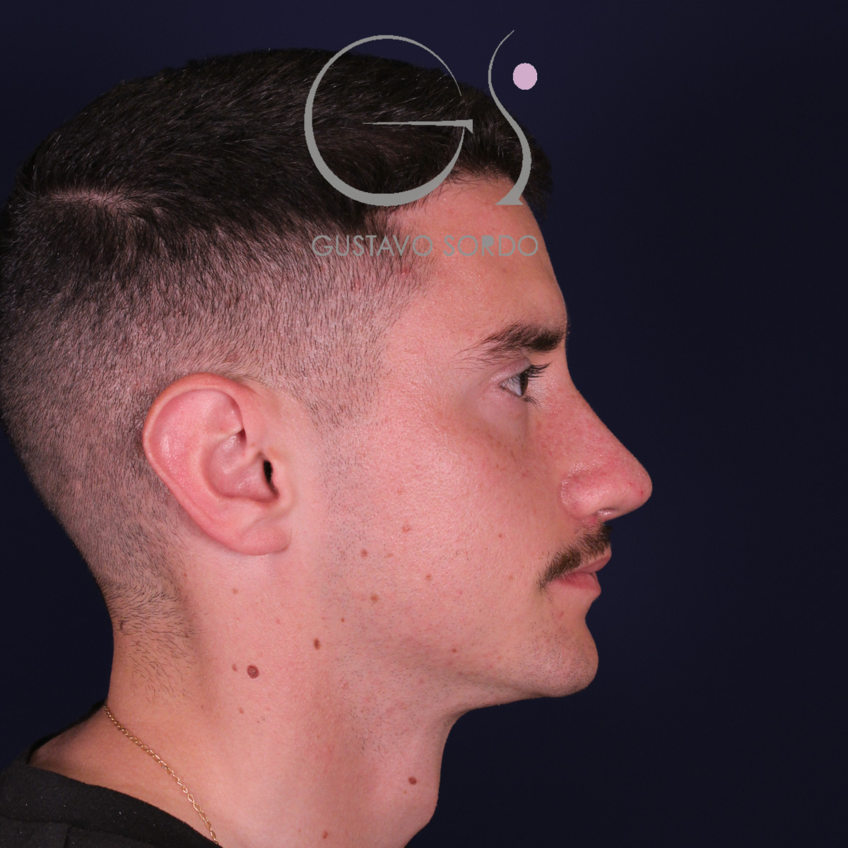 Rinoplastia de preservación low strip en desviación axial de la pirámide, perfil derecho, al año de la operación