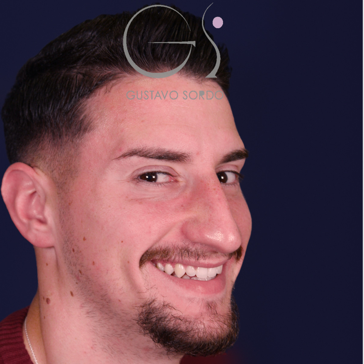 Rinoplastia de preservación low strip en desviación axial de la pirámide, semiperfil derecho sonriendo, antes de la operación