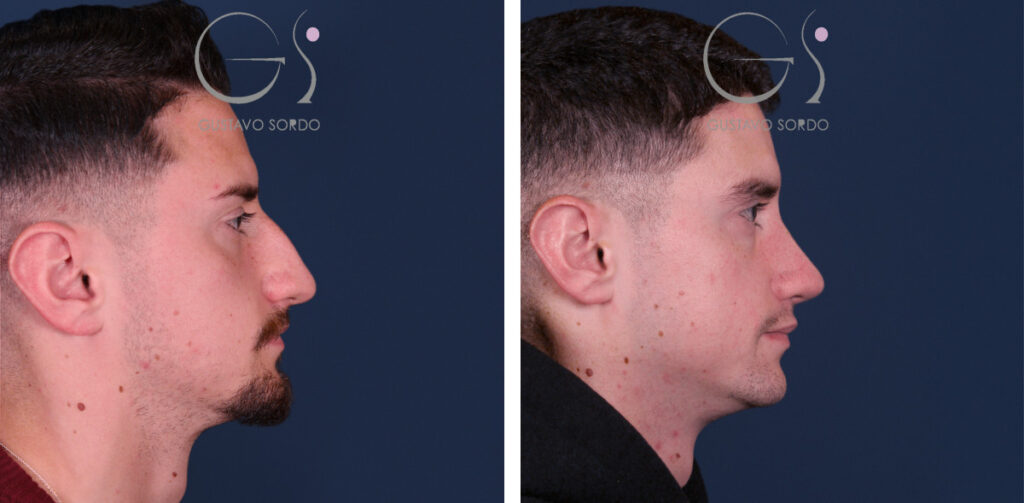 Rinoplastia — en hombre: antes y después de un caso operado en Madrid