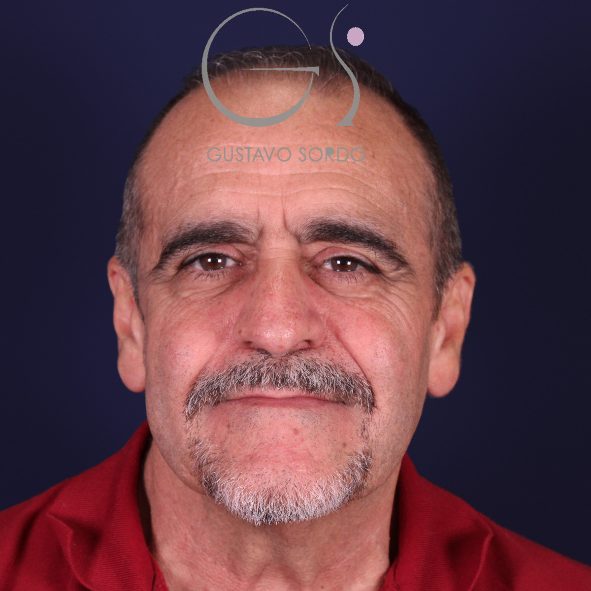 Rinoplastia de preservación en nariz con rinofima y piel gruesa, vista frontal, antes de la operación