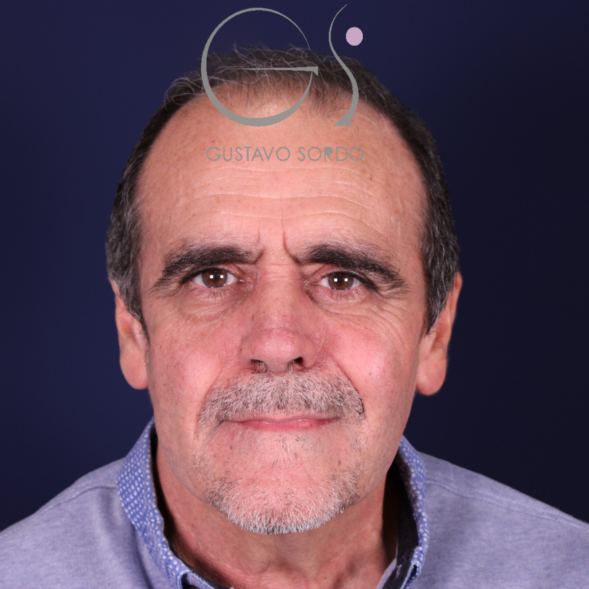 Rinoplastia de preservación en nariz con rinofima y piel gruesa, vista frontal, después de la operación