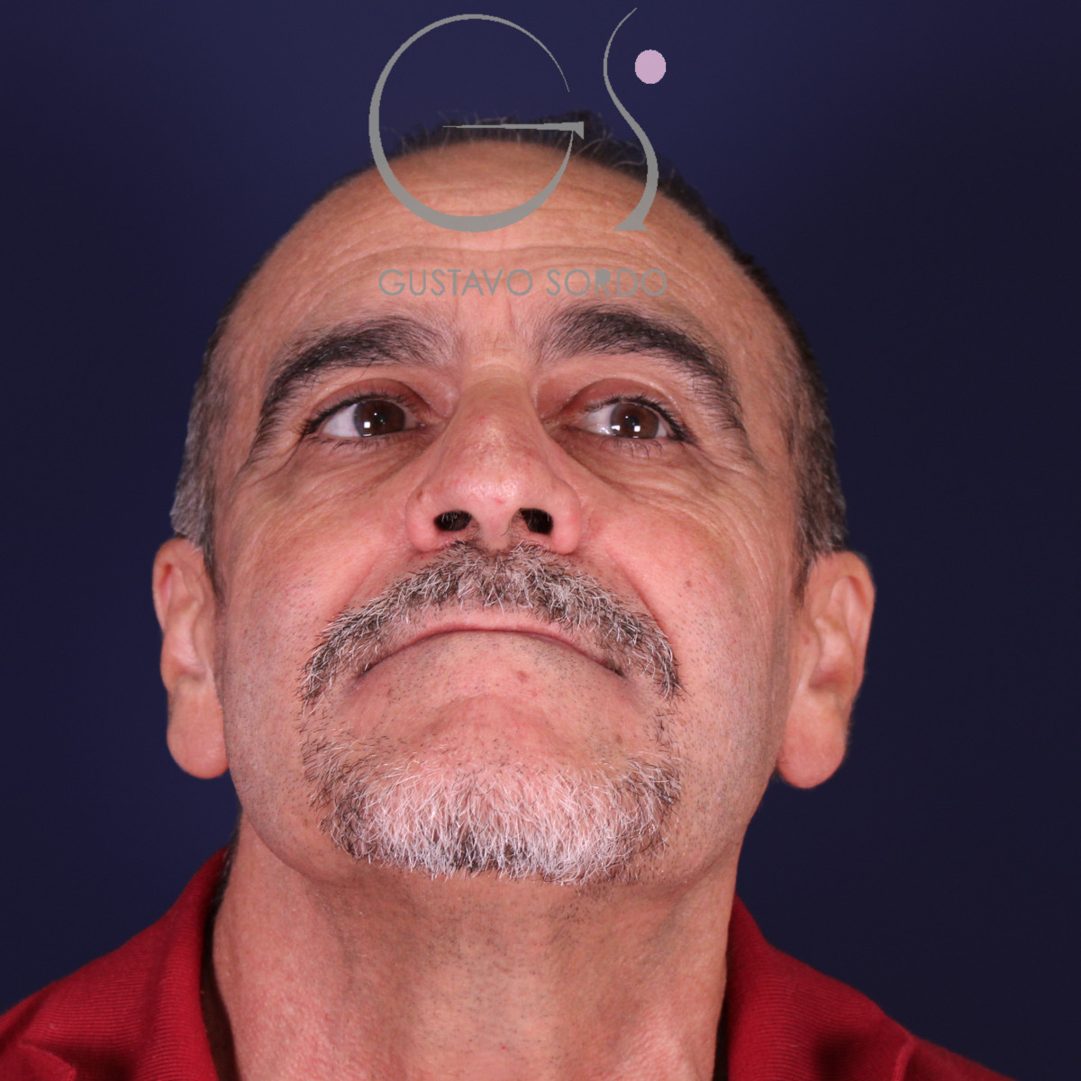 Rinoplastia de preservación en nariz con rinofima y piel gruesa, mentón arriba, antes de la operación