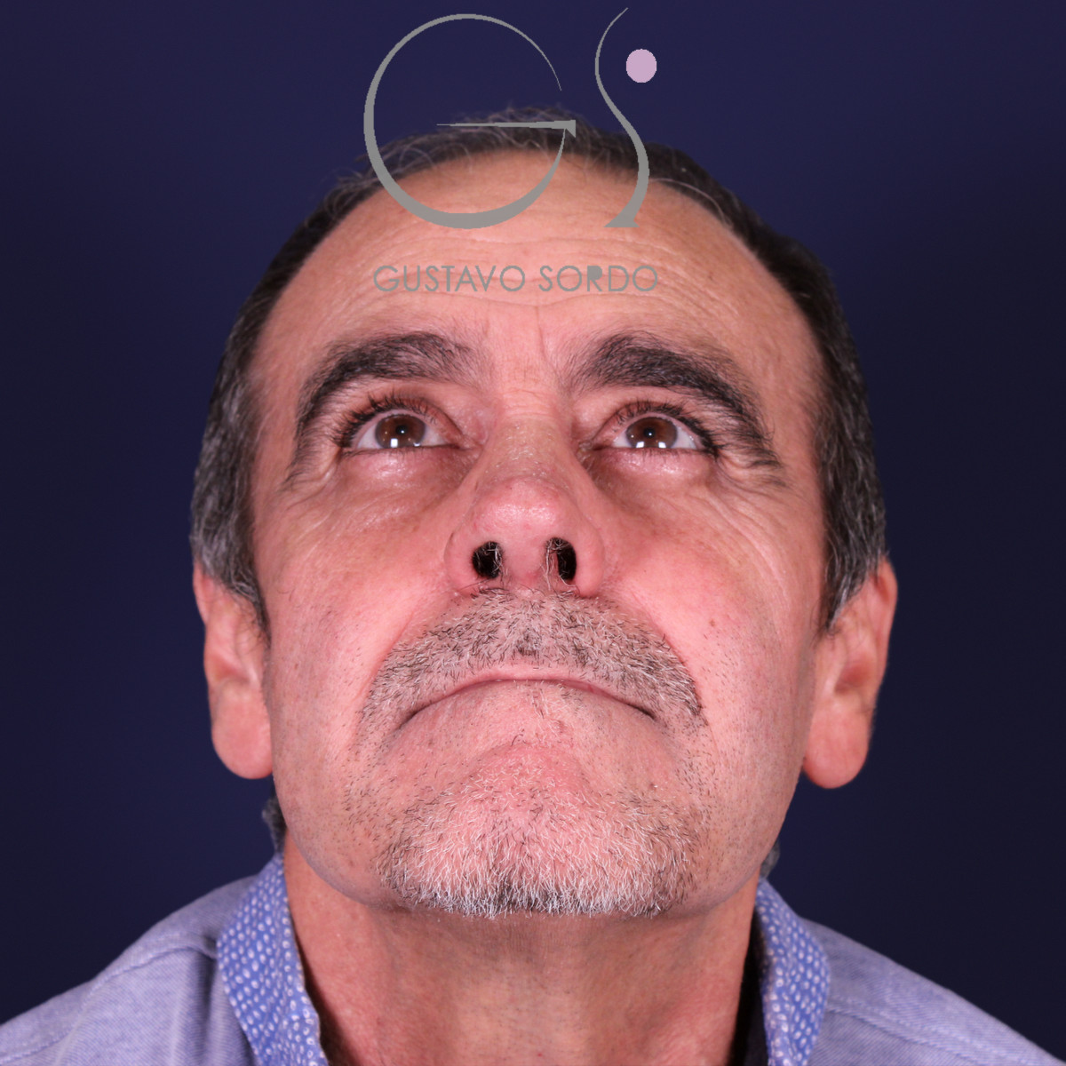 Rinoplastia de preservación en nariz con rinofima y piel gruesa, mentón arriba, después de la operación