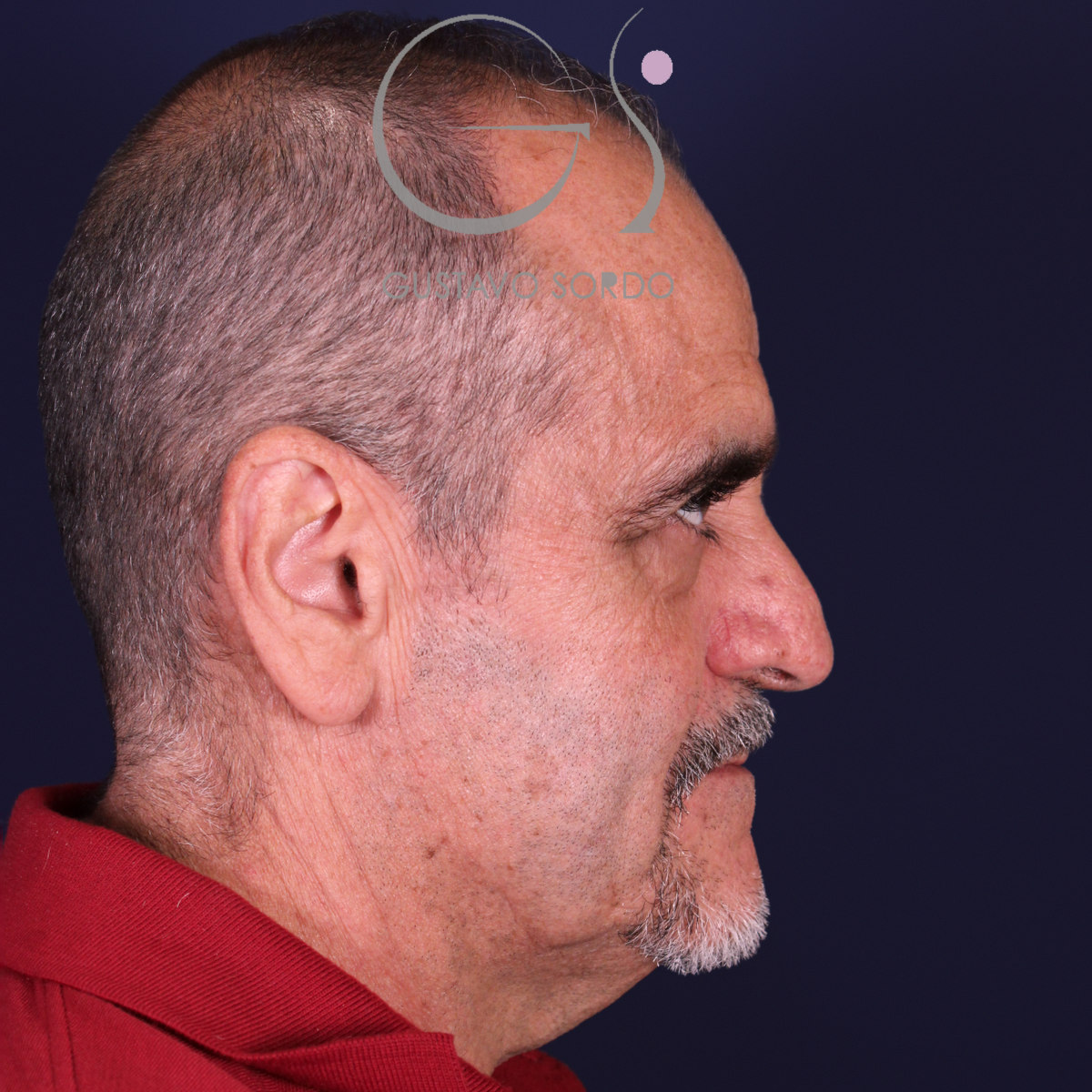 Rinoplastia de preservación en nariz con rinofima y piel gruesa, perfil derecho, antes de la operación