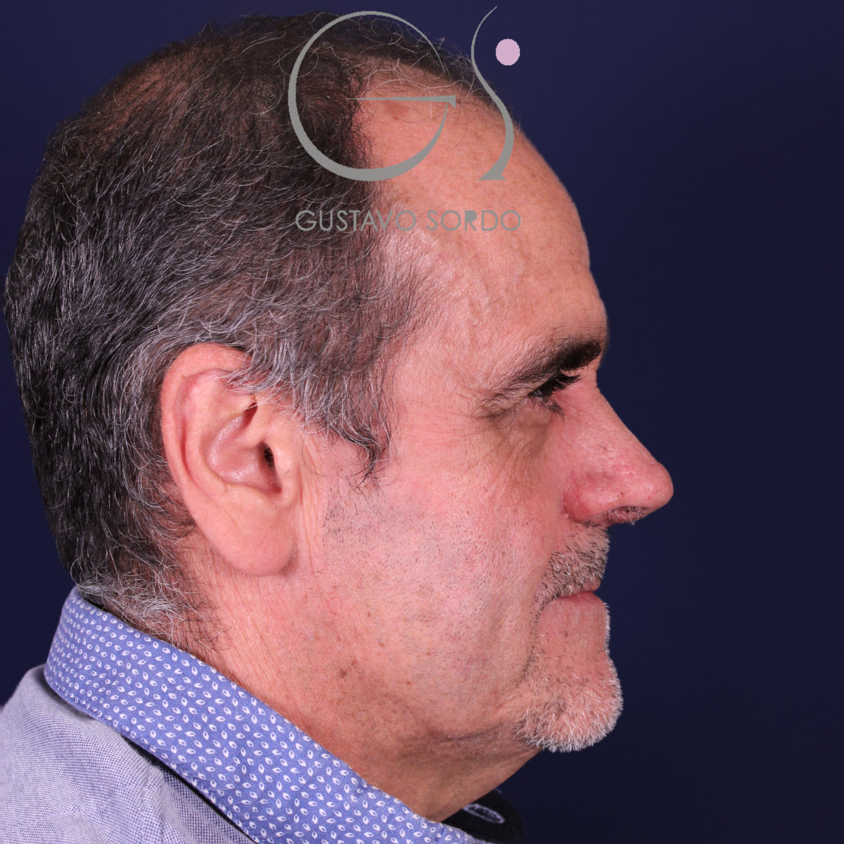 Rinoplastia de preservación en nariz con rinofima y piel gruesa, perfil derecho, después de la operación