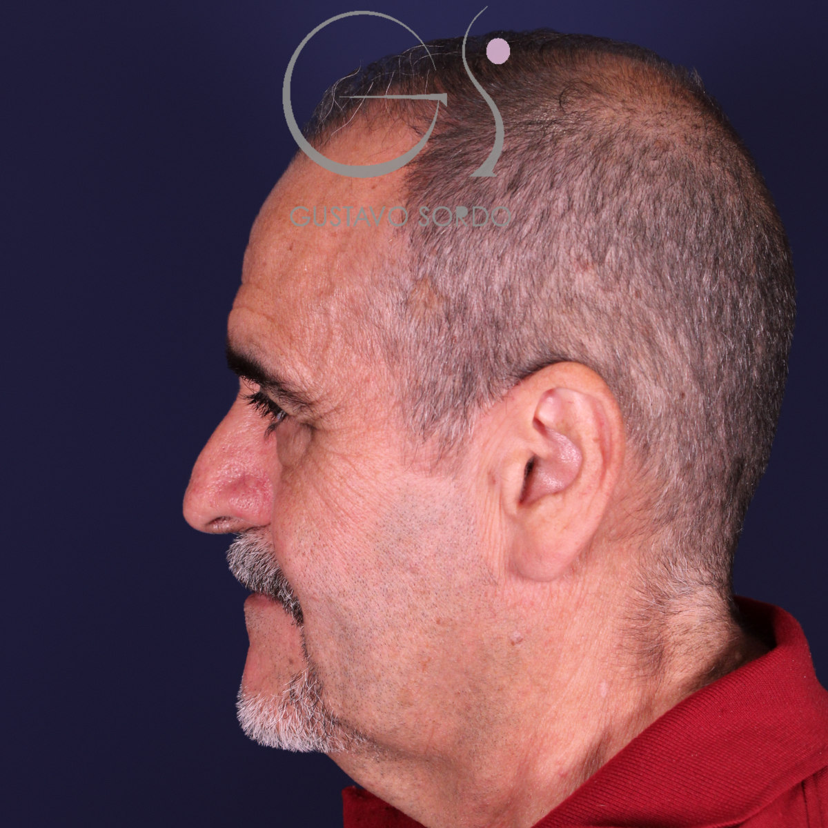 Rinoplastia de preservación en nariz con rinofima y piel gruesa, perfil izquierdo, antes de la operación