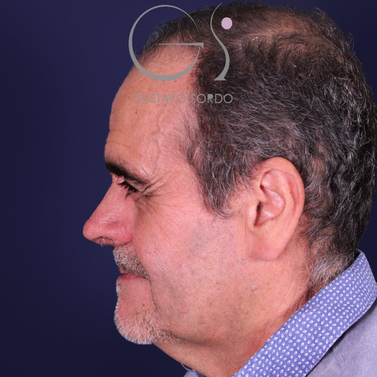 Rinoplastia de preservación en nariz con rinofima y piel gruesa, perfil izquierdo, después de la operación