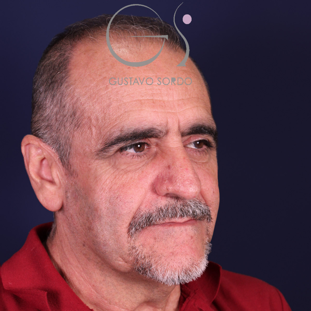 Rinoplastia de preservación en nariz con rinofima y piel gruesa, semiperfil derecho, antes de la operación