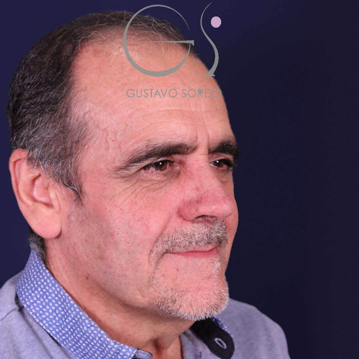 Rinoplastia de preservación en nariz con rinofima y piel gruesa, semiperfil derecho, después de la operación