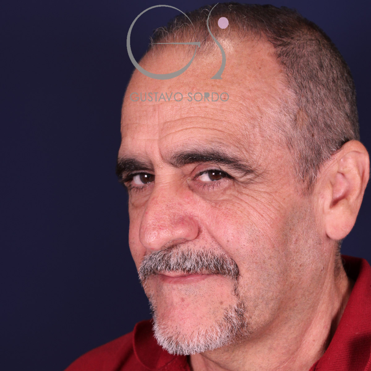 Rinoplastia de preservación en nariz con rinofima y piel gruesa, semiperfil izquierdo, antes de la operación