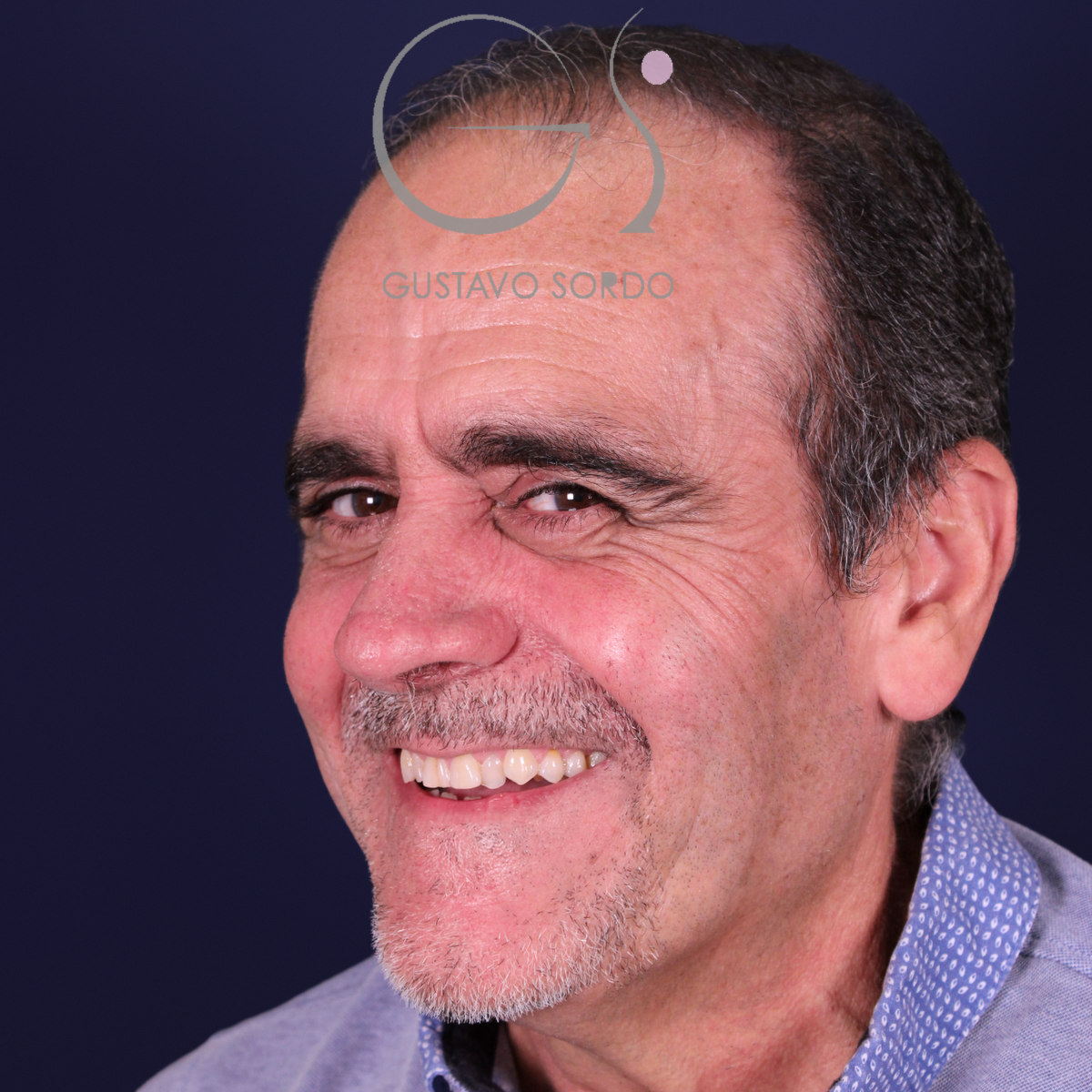 Rinoplastia de preservación en nariz con rinofima y piel gruesa, semiperfil izquierdo, después de la operación