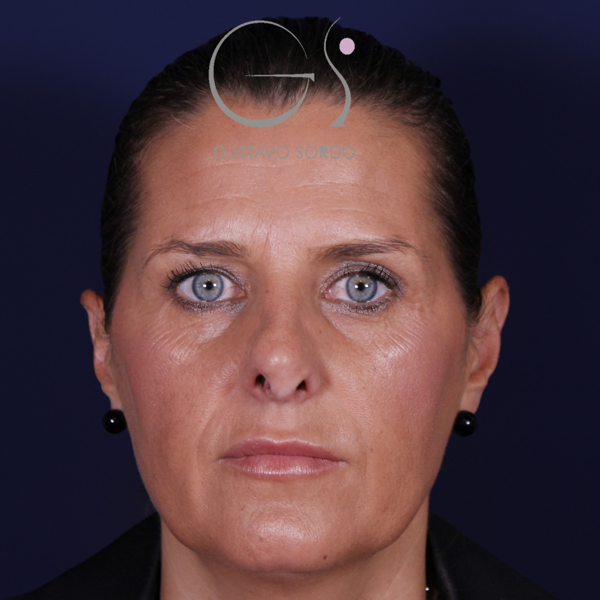 Rinoplastia secundaria, vista frontal, antes de la operación