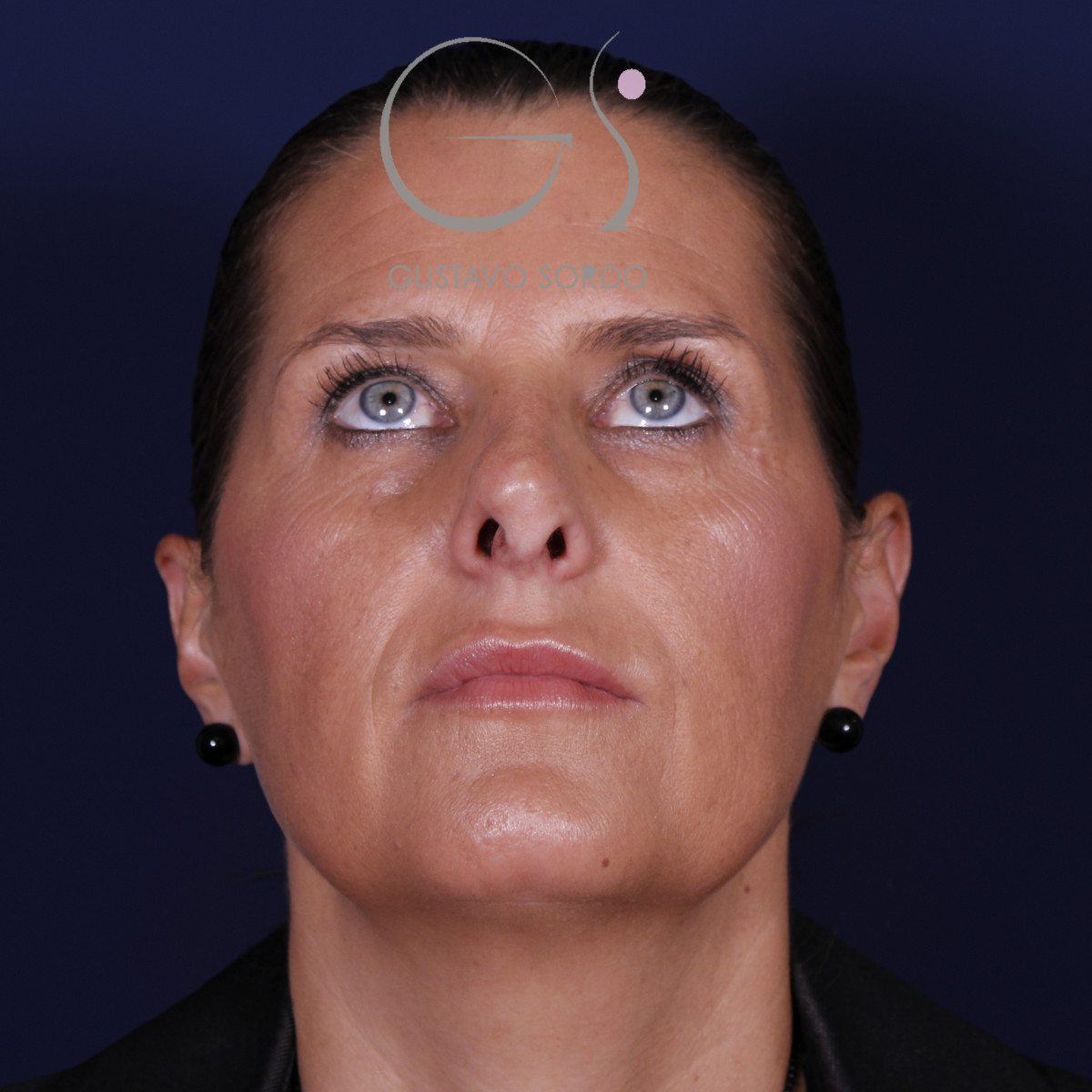 Rinoplastia secundaria, mentón arriba, antes de la operación
