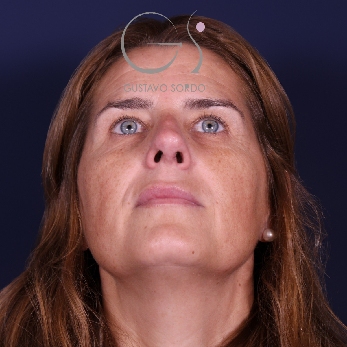 Rinoplastia secundaria, mentón arriba, al año de la operación