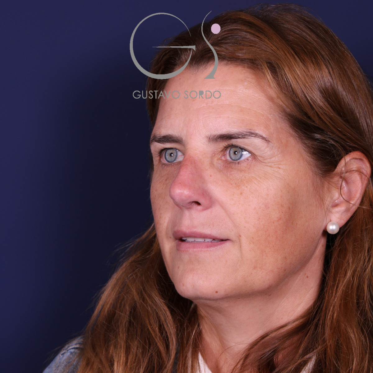 Rinoplastia secundaria, semiperfil izquierdo, al año de la operación