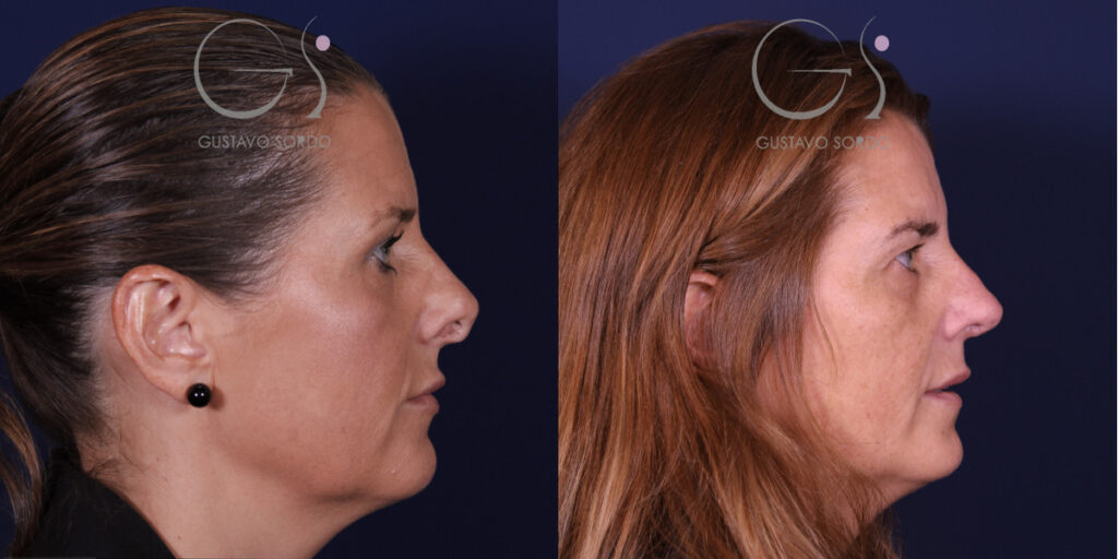 Rinoplastia secundaria: perfil — antes y después. Caso operado en la Clínica Dr. Gustavo Sordo, Madrid