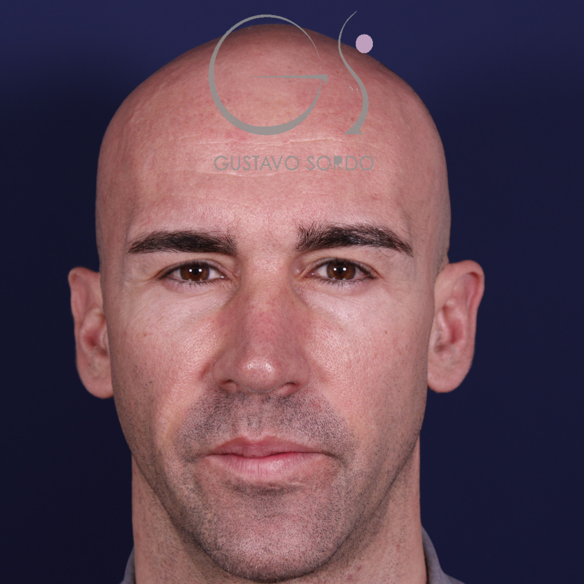 Rinoplastia ultrasónica en hombre con septoplastia y turbinoplastia, vista frontal, a los 6 meses de la operación