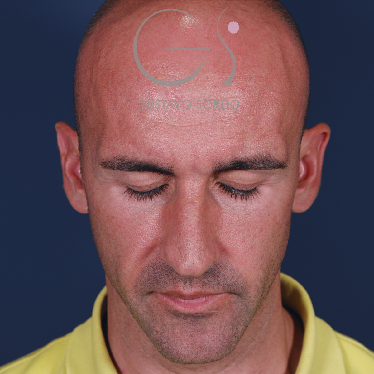 Rinoplastia ultrasónica en hombre con septoplastia y turbinoplastia, mentón abajo, antes de la operación