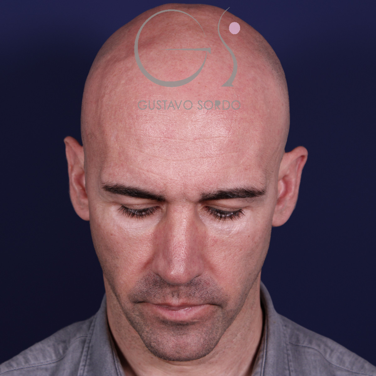 Rinoplastia ultrasónica en hombre con septoplastia y turbinoplastia, mentón abajo, a los 6 meses de la operación