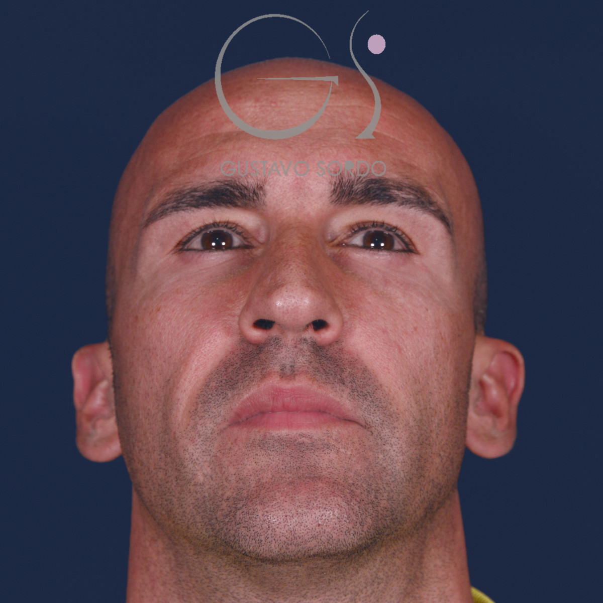 Rinoplastia ultrasónica en hombre con septoplastia y turbinoplastia, mentón arriba, antes de la operación