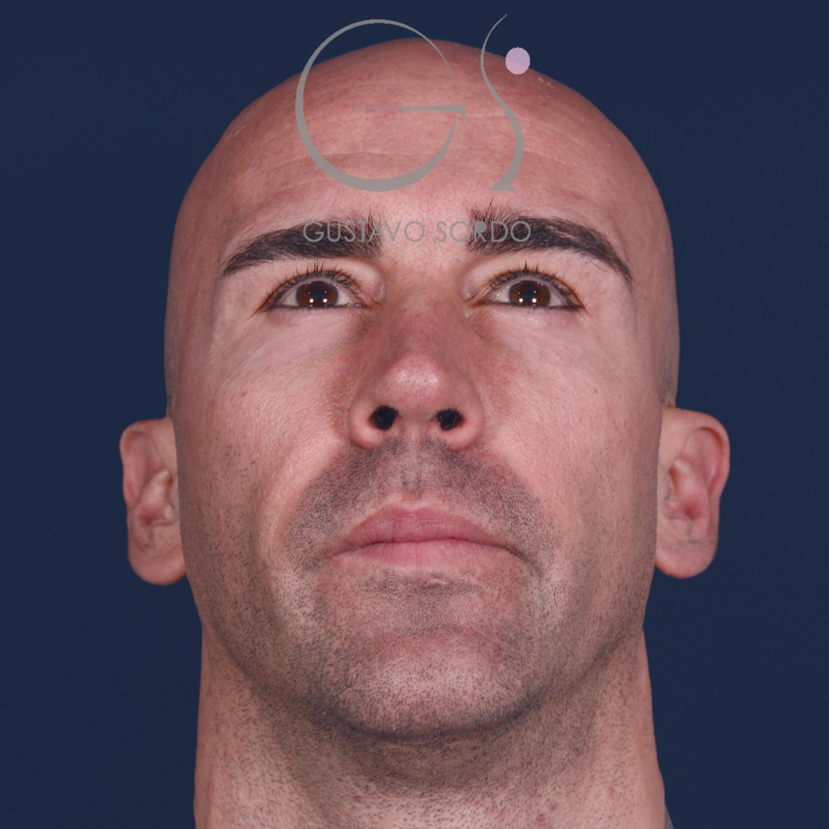 Rinoplastia ultrasónica en hombre con septoplastia y turbinoplastia, mentón arriba, a los 6 meses de la operación