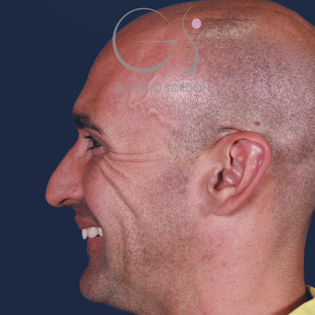 Rinoplastia ultrasónica en hombre con septoplastia y turbinoplastia, perfil izquierdo sonriendo, antes de la operación